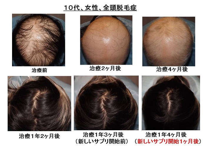 白髪・脱毛・育毛の実際 概要）アンチ・エイジングシリーズ1 白髪・脱毛・育毛の実際